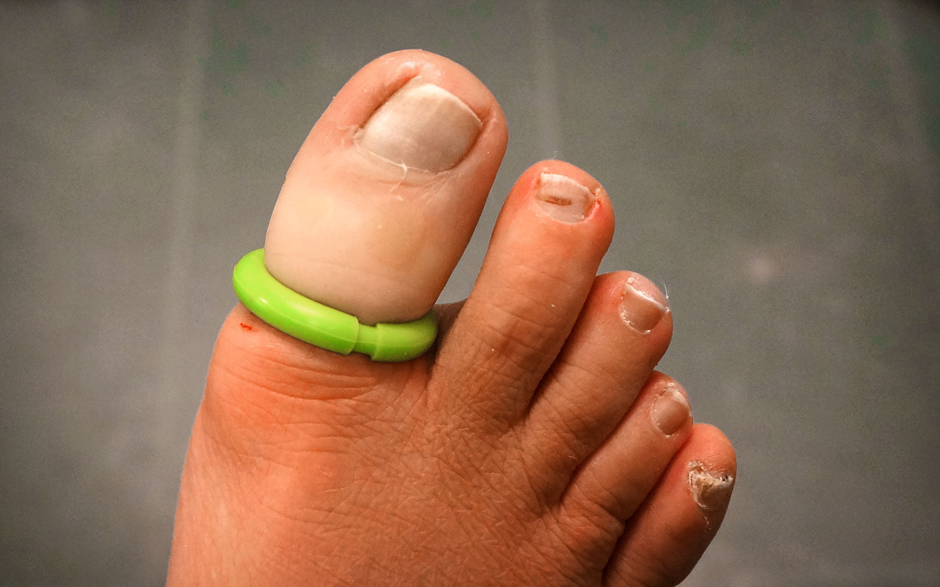 Leaving ingrown toenails untreated can lead to infection. This can escalate the pain and discomfort while also posing a risk to your overall health.